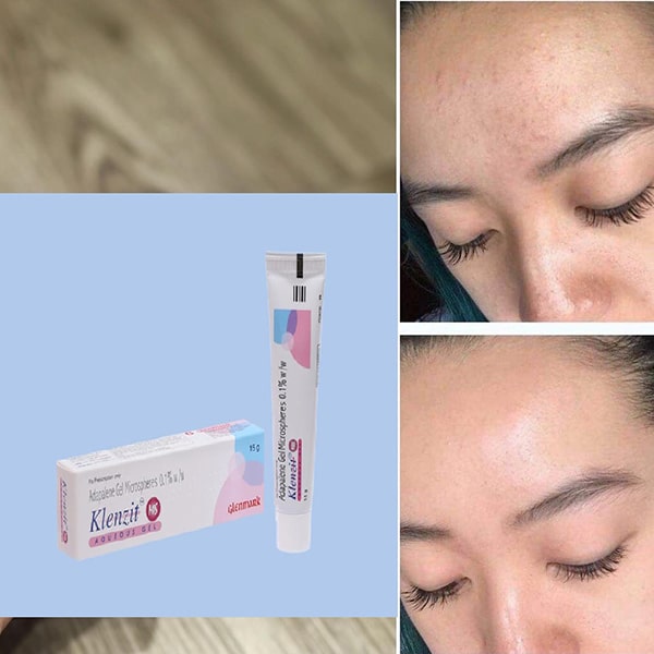 Gel trị mụn Klenzit